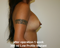 plastic-surgery-breast-augmentation